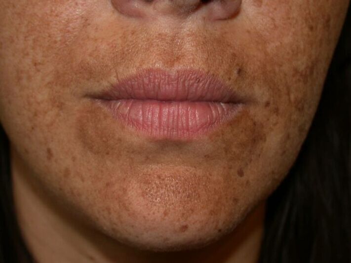 As manchas de pigmento na cara son unha indicación da cirurxía con láser