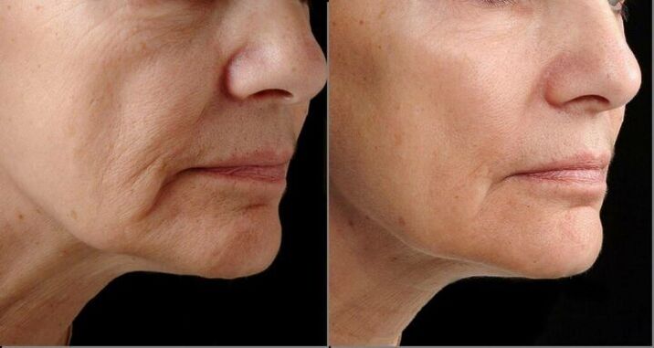Pel facial antes e despois do rexuvenecemento con láser