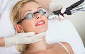 Procedemento láser para o rexuvenecemento da pel facial