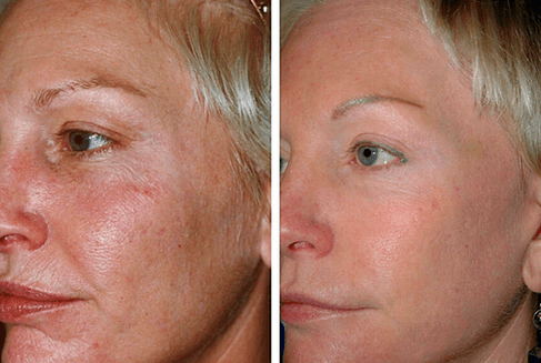 antes e despois do rexuvenecemento da pel fraccionado foto 1