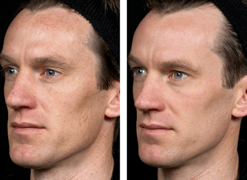 antes e despois do rexuvenecemento da pel fraccionado foto 5