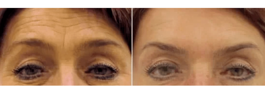 Dispositivos de rexuvenecemento fraccionado