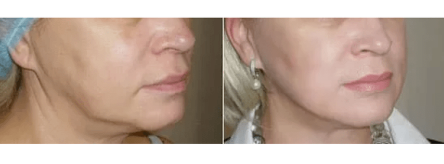 Recuperación despois do rexuvenecemento da pel