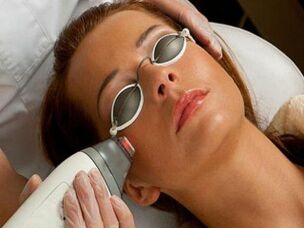 Rexuvenecemento facial con láser